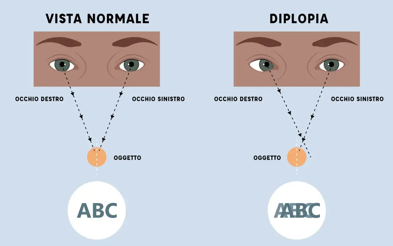 Vista normale vs. diplopia: i raggi luminosi da un oggetto convergono correttamente in un occhio, ma si sdoppiano nell'altro. Te lo leggo negli occhi.